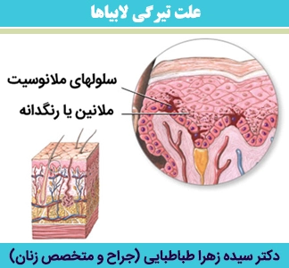 علت-تیرگی-لابیاها