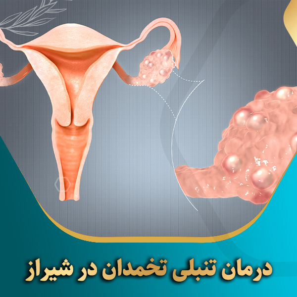 درمان-تنبلی-تخمدان-در-شیراز