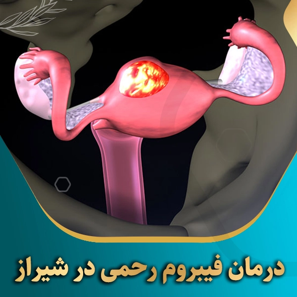 درمان-فیبروم-رحمی-در-شیراز