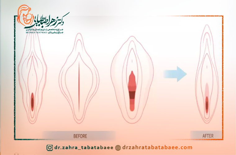 لابیاپلاستی