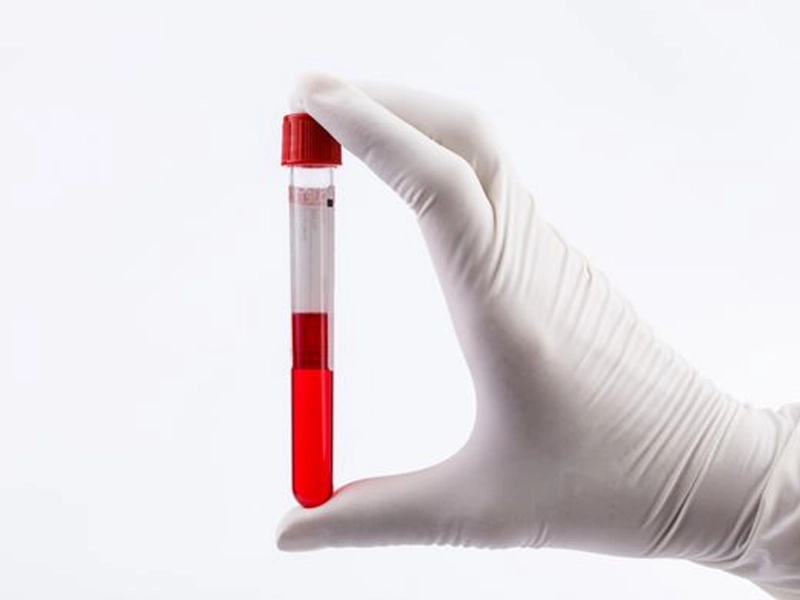 پلاسماتراپی واژن در شیراز